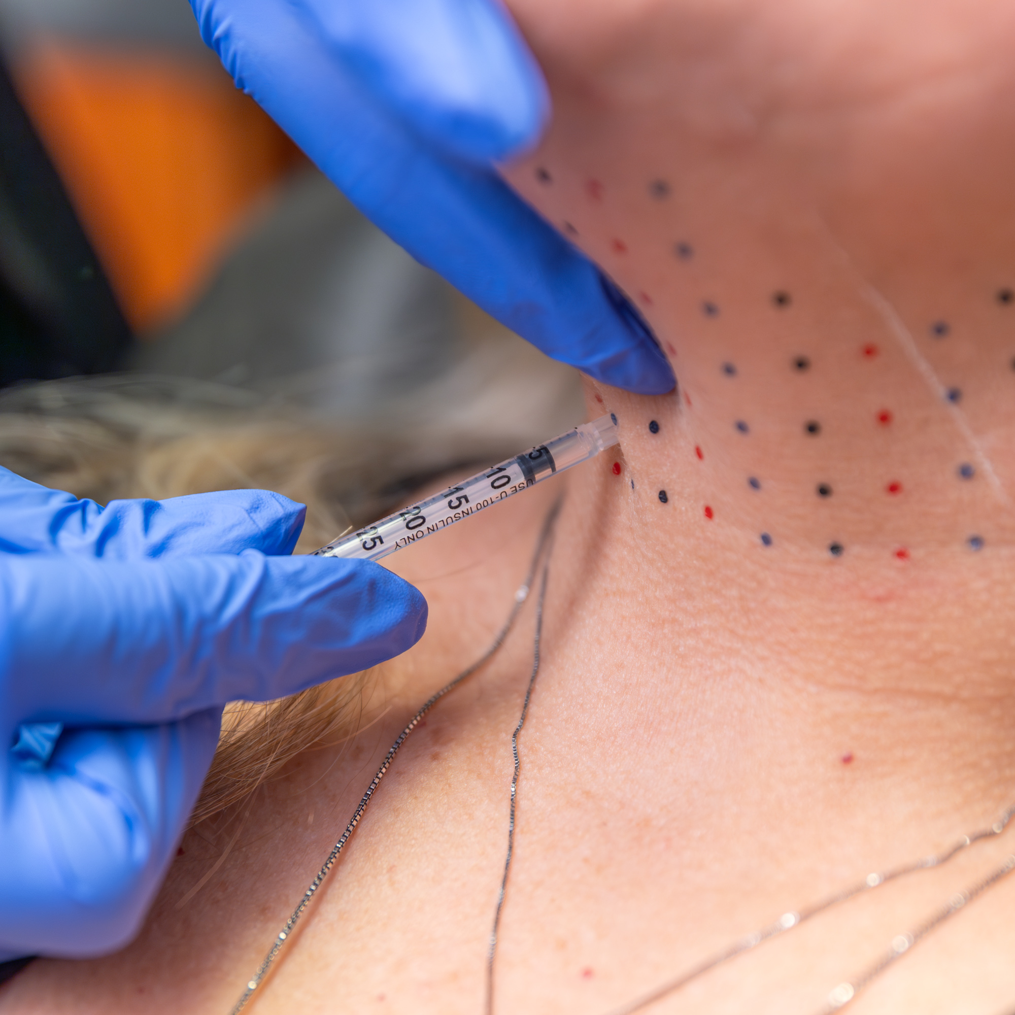 Close up of a Kybella treatment on a womans neck for at a med spa in Belle Meade