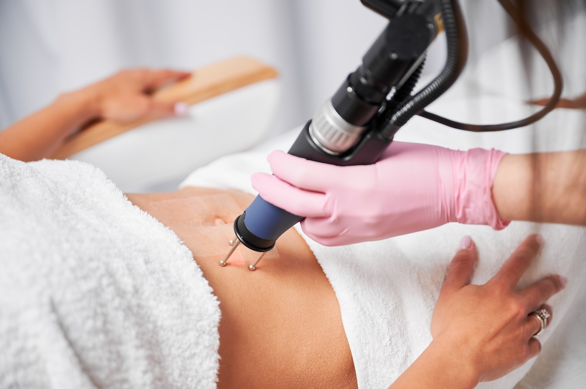 Close up of laser skin resurfacing treatment on a woman lying down