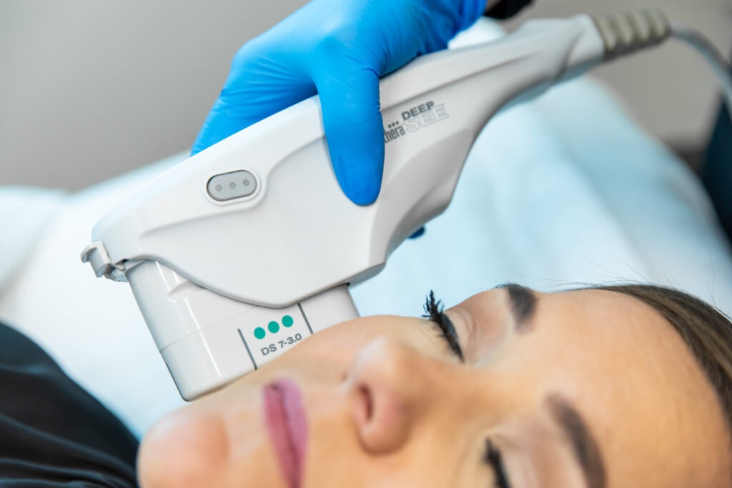 Clopse up of an Ultherapy treatment for skin tightening in East Nashville